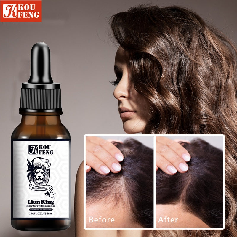 KouFeng Fast and Effective Hair Growth Essential Oil Hair Care Anti-Hair Loss Beauty Products Fast Growth Repair Scalp Allergies